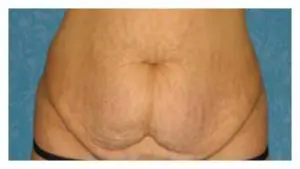 Before & After Pictures in St. Augustine, FL 