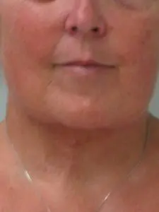 Before & After Pictures in St. Augustine, FL 