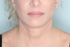 Before & After Pictures in St. Augustine, FL 
