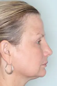 Before & After Pictures in St. Augustine, FL 