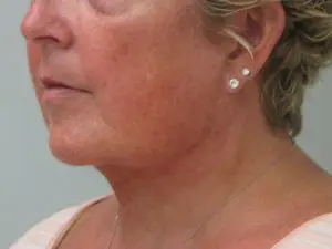 Before & After Pictures in St. Augustine, FL 