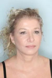 Before & After Pictures in St. Augustine, FL 