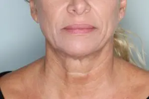 Before & After Pictures in St. Augustine, FL 