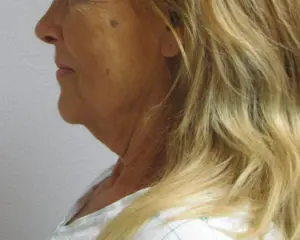 Before & After Pictures in St. Augustine, FL 