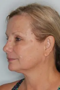 Before & After Pictures in St. Augustine, FL 