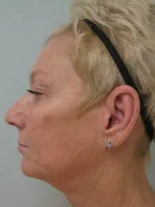 Before & After Pictures in St. Augustine, FL 