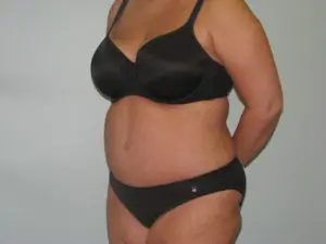 Before & After Pictures in St. Augustine, FL 