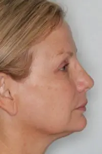 Before & After Pictures in St. Augustine, FL 