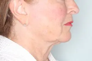 Before & After Pictures in St. Augustine, FL 