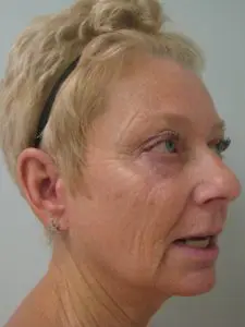 Before & After Pictures in St. Augustine, FL 