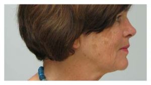 Before & After Pictures in St. Augustine, FL 