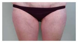 Before & After Pictures in St. Augustine, FL 