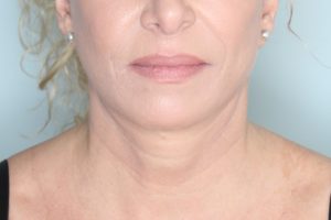 Before & After Pictures in St. Augustine, FL 