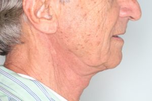 Before & After Pictures in St. Augustine, FL 