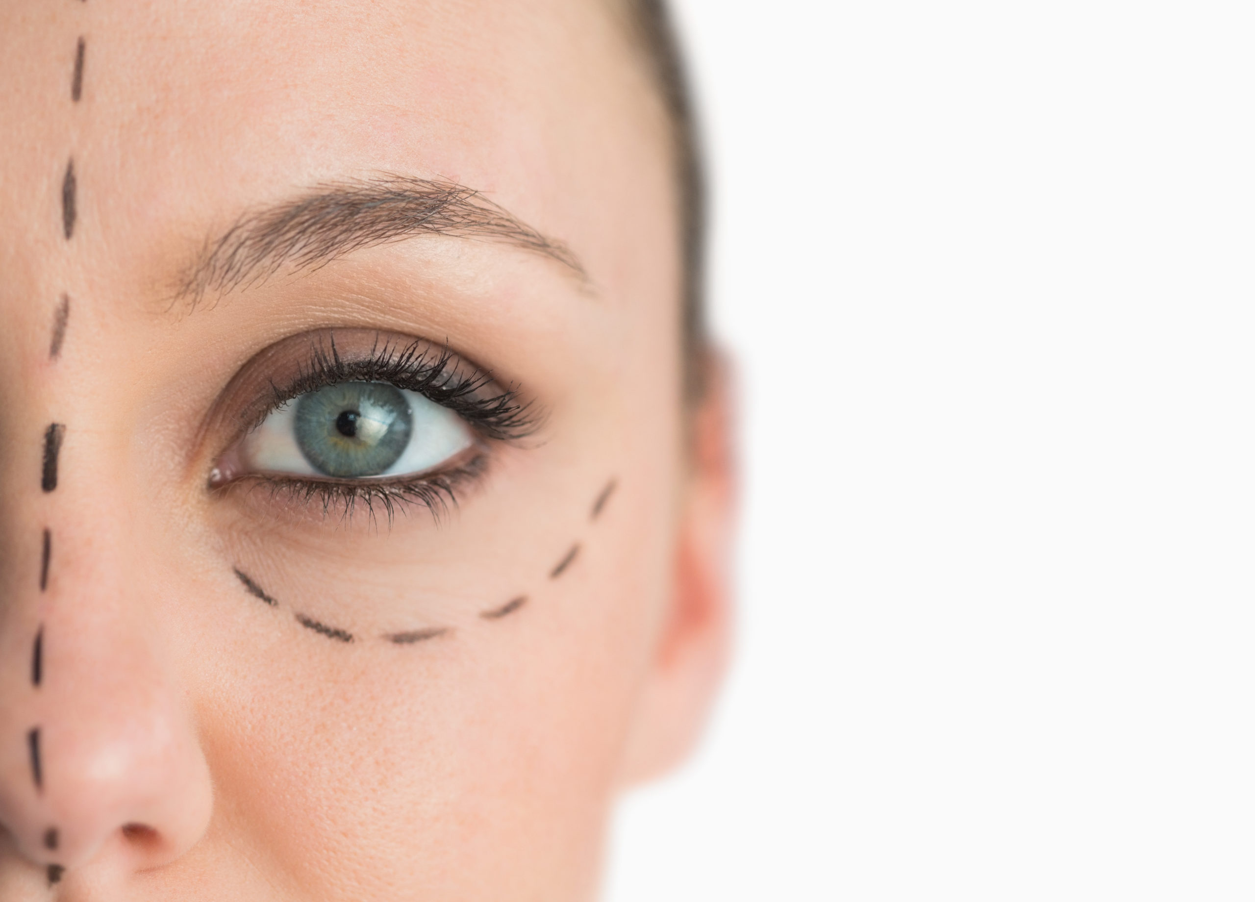 Blepharoplasty (Eyelid Surgery) in St. Augustine, FL