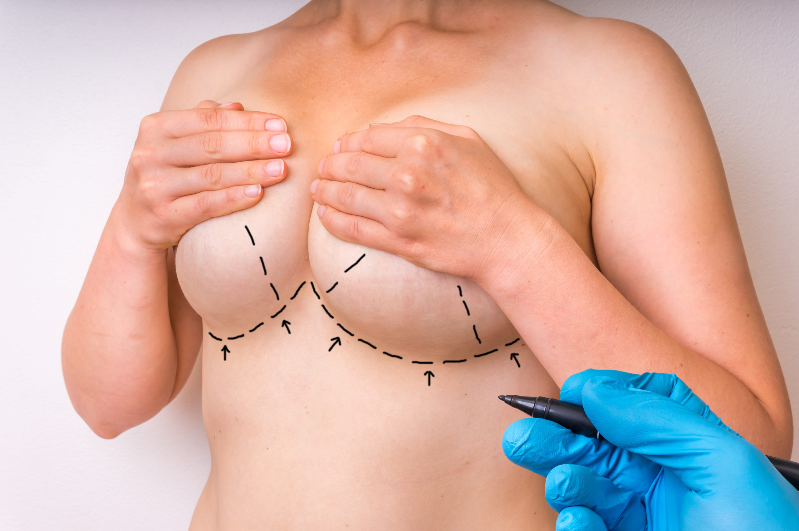 Breast Reduction in St. Augustine, FL